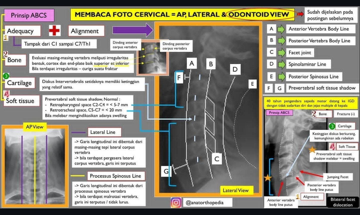 Ilustrasi Miles Procedure