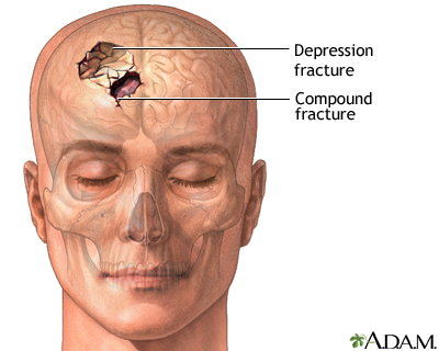 Ilustrasi Depressed Fracture