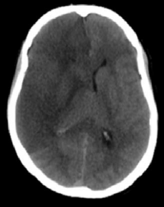 Ilustrasi Traumatic Cerebral Edema