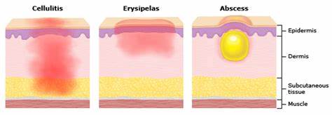 Ilustrasi Perbedaan Abses, Selulitis, Phlegmon