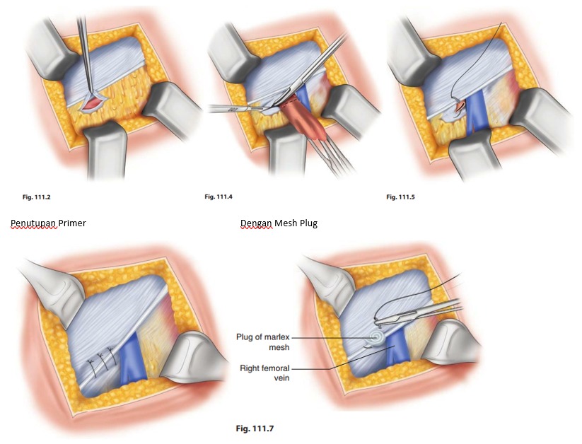 Ilustrasi Hernia repair : Femoral Hernia