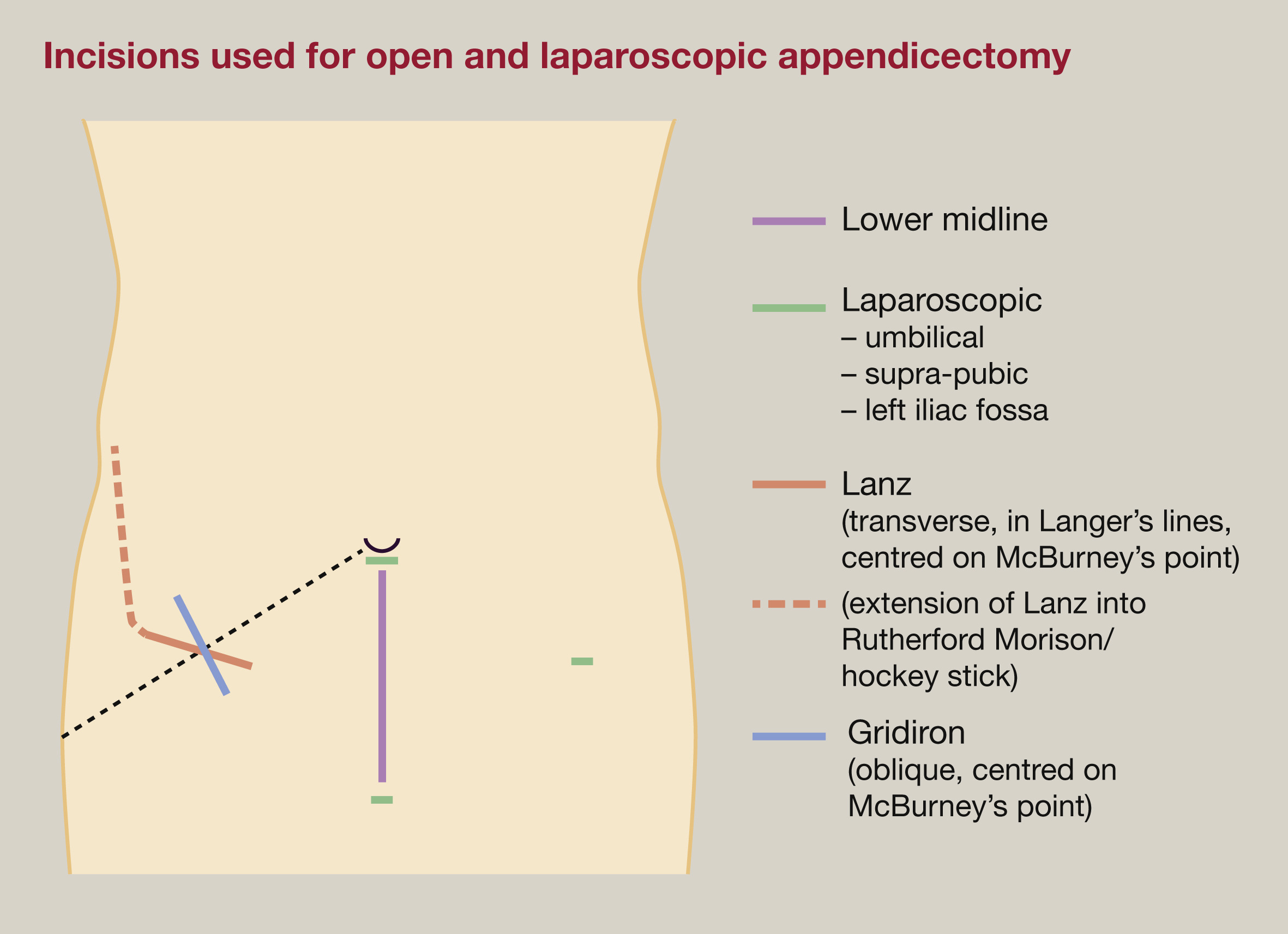 Foto artikel Apendektomi (Appendectomy)