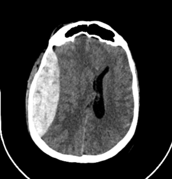 Ilustrasi Epidural Hematoma (EDH)