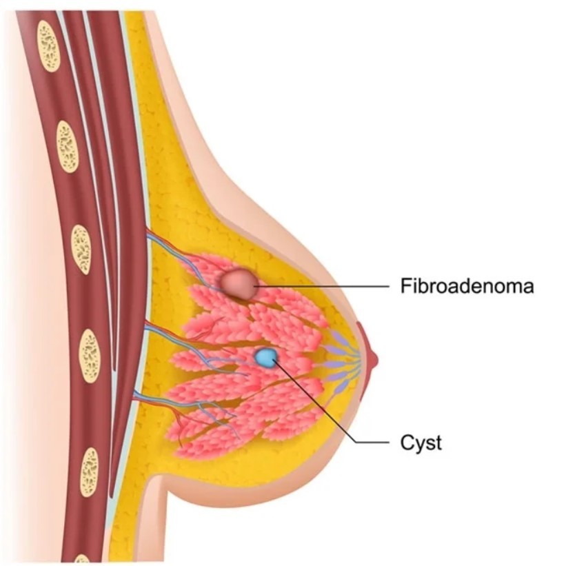Foto artikel Fibroadenoma Mamma (FAM)