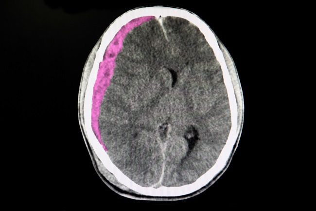 Ilustrasi Subdural Hematoma (SDH)
